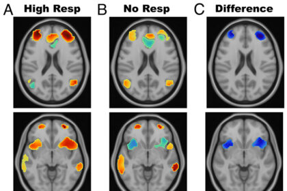 We may finally know why magnetic stimulation on the brain can alleviate depression: ScienceAlert