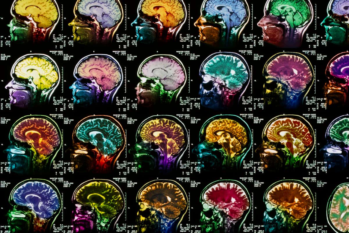 Magnetic resonance imaging scans showing healthy healthy brains