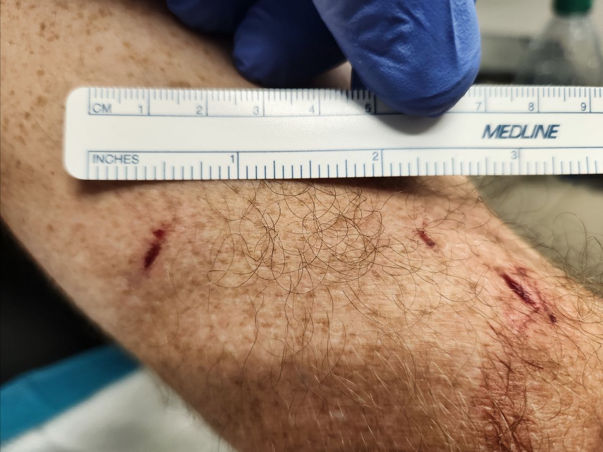 Bear bites Colorado camper who was relaxing in a hammock