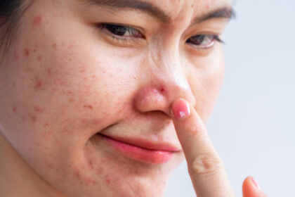 Bacteria Responsible For Acne Were Genetically Modified to Treat It Instead : ScienceAlert