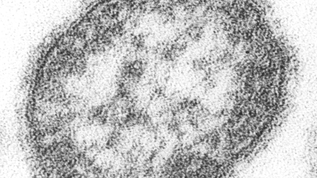 Florida health officials providing scant details on measles cases